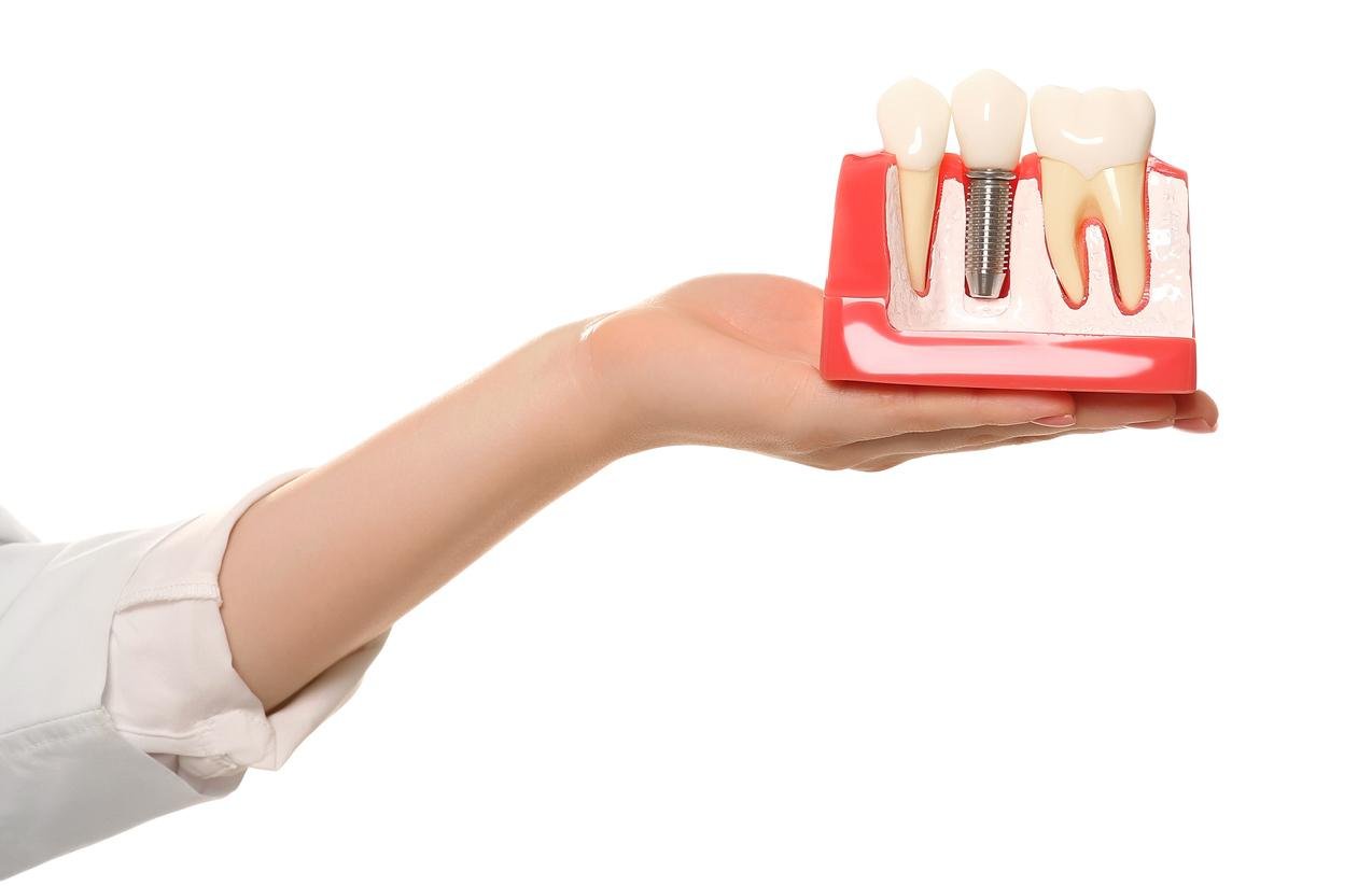 Restore your smile with high-quality dental implants in Mississauga. Safe and long-lasting dental implants for a natural and confident smile. Strong, permanent teeth with advanced dental implant technology. Smile with confidence again – discover the benefits of dental implants. Missing a tooth? Dental implants are the perfect solution for tooth replacement. Complete and functional smile with the best dental implants in Mississauga. Say goodbye to loose dentures! Dental implants offer stability and comfort. Dental implants that look, feel, and function like natural teeth. Personalized dental implant treatments to restore your confidence. Book a consultation today to see if dental implants are right for you.